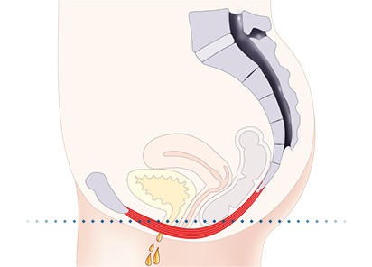 Pelvic-Floor Muscle Repair 5 Pelvic floor muscles Cheltenham